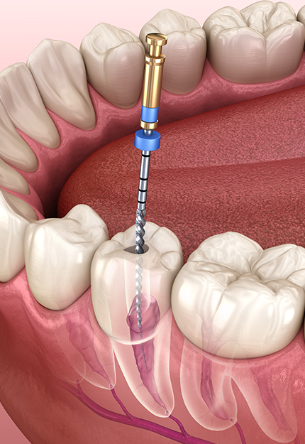 ISIMDANG  자연치아 살리기